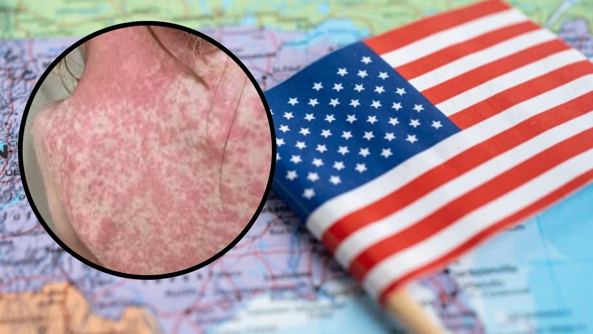 Sarampión en Estados Unidos, cifras alarmantes.