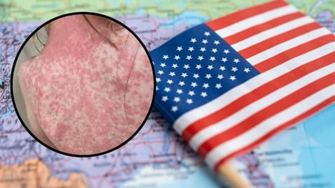 Sarampión en Estados Unidos, cifras alarmantes.