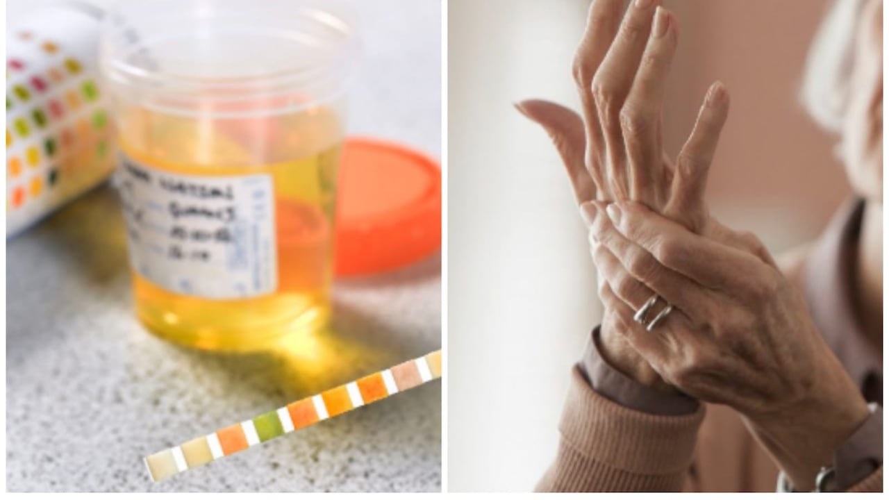 El ácido úrico elevado produce dolor principalmente en las articulaciones.