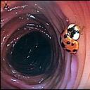 Tras una colonoscopia un hombre descubre que tiene un insecto viviendo en su intestino