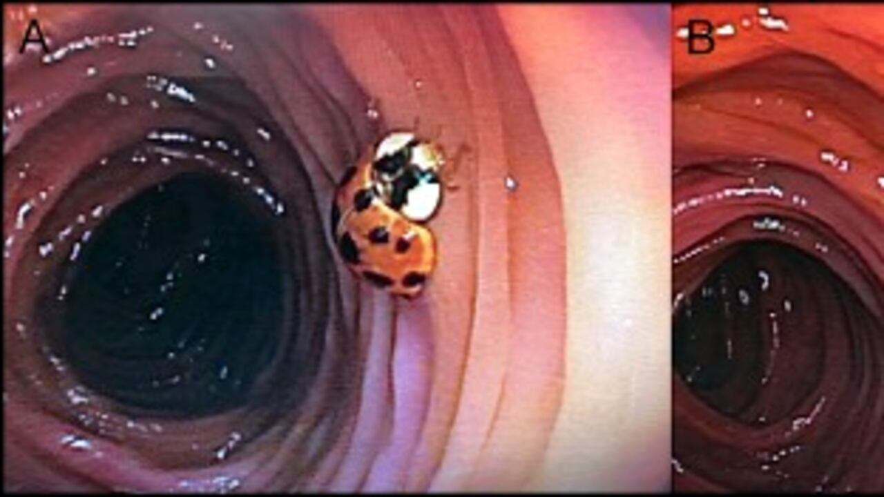 Tras una colonoscopia un hombre descubre que tiene un insecto viviendo en su intestino