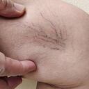 Las várices son problemas circulatorios.