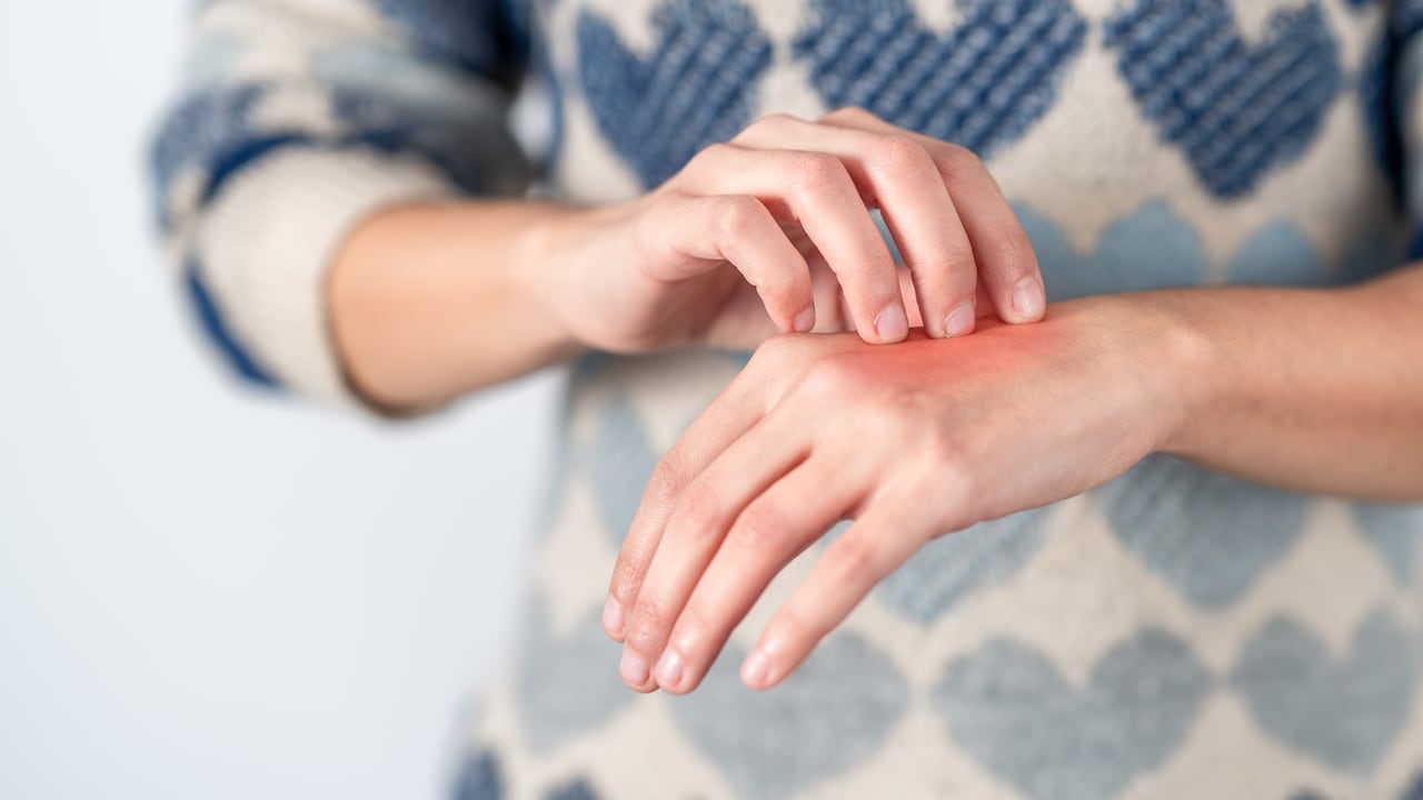 Young woman scratching her itchy hand. Concept skin problem, allergy and dermatology