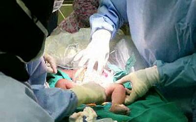 Operación exitosa a siamesas