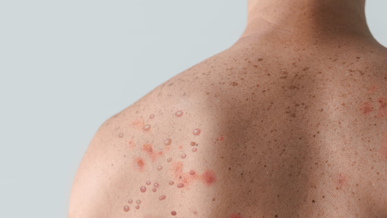 Los casos graves son especialmente frecuentes en niños pequeños malnutridos