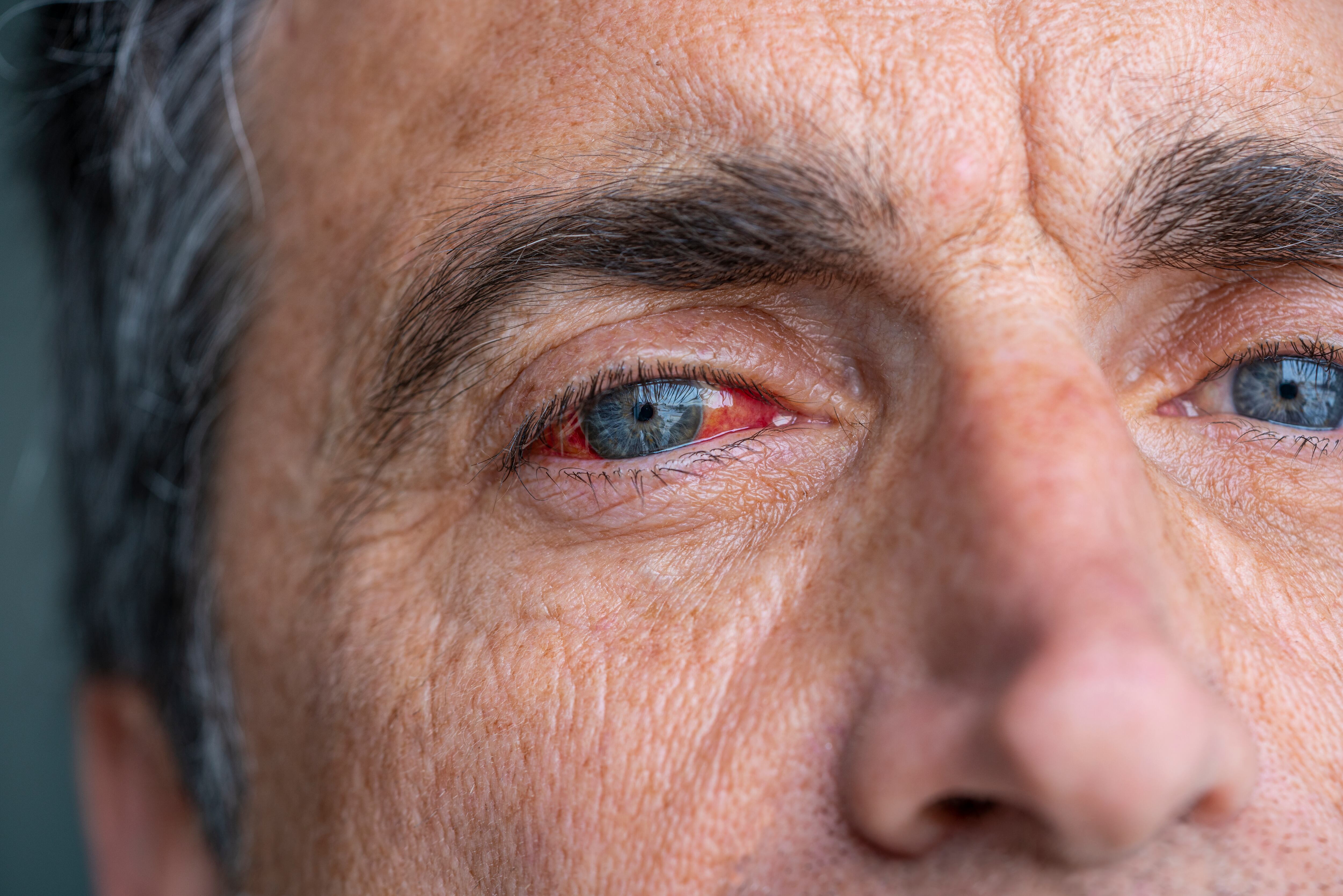 La pérdida de la visión puede desarrollarse por presión arterial alta.