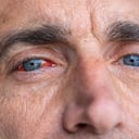 La pérdida de la visión puede desarrollarse por presión arterial alta.