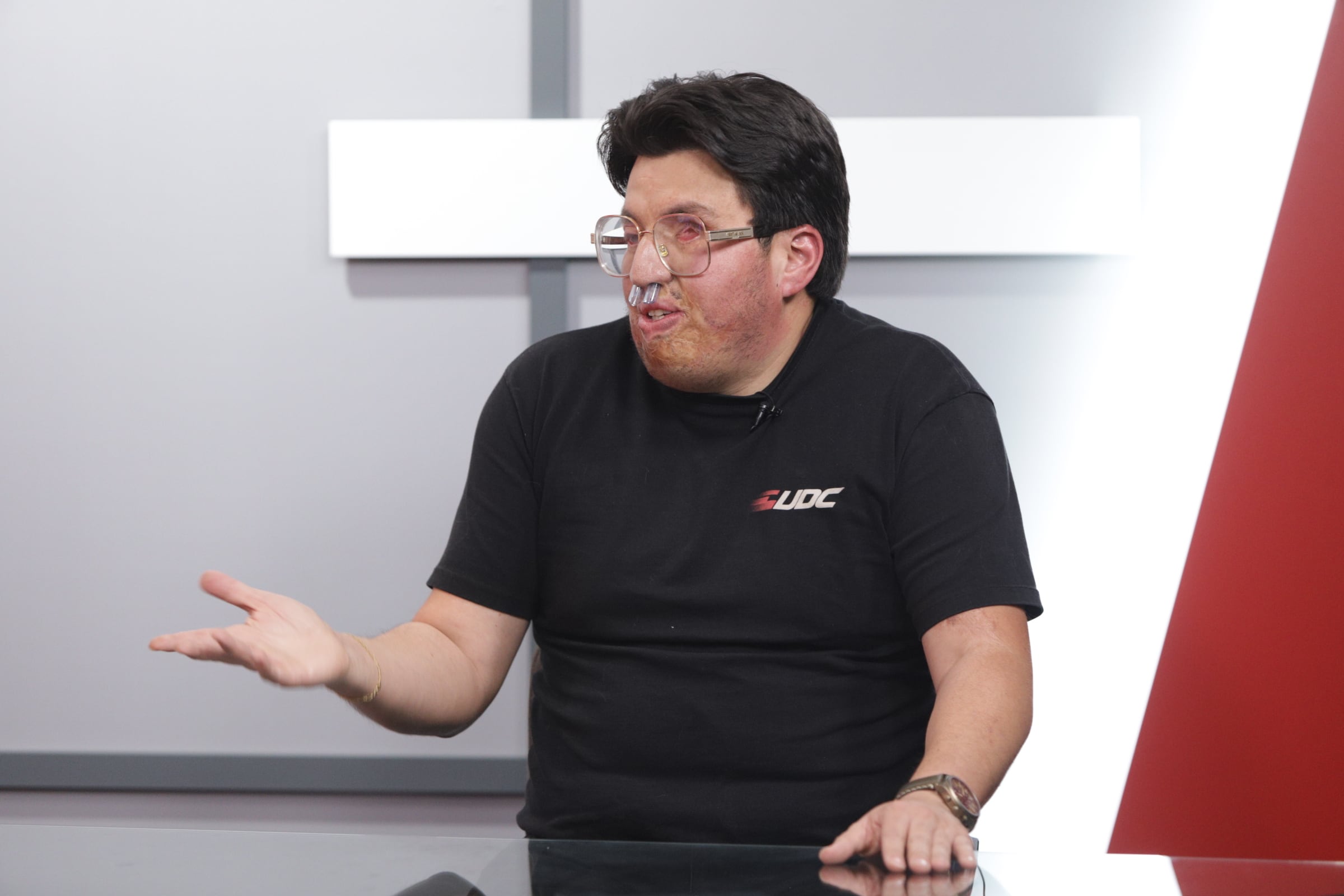 Sergio Mogollón, víctima de ataque de ácido