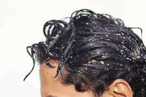 La caspa puede causar problemas de autoestima.