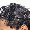 La caspa puede causar problemas de autoestima.