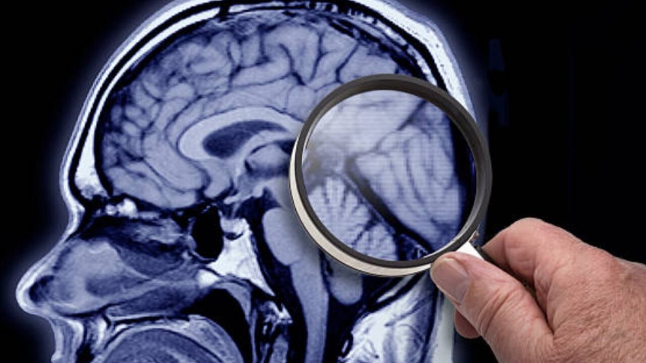 Alzhéimer: ¿cómo detectar temprano la enfermedad?