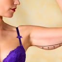 Plastic surgery marks to remove excess skin/fat on woman's flabby arms.