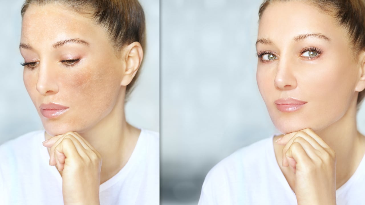 Manchas solares en la piel: cómo eliminarlas con remedios naturales