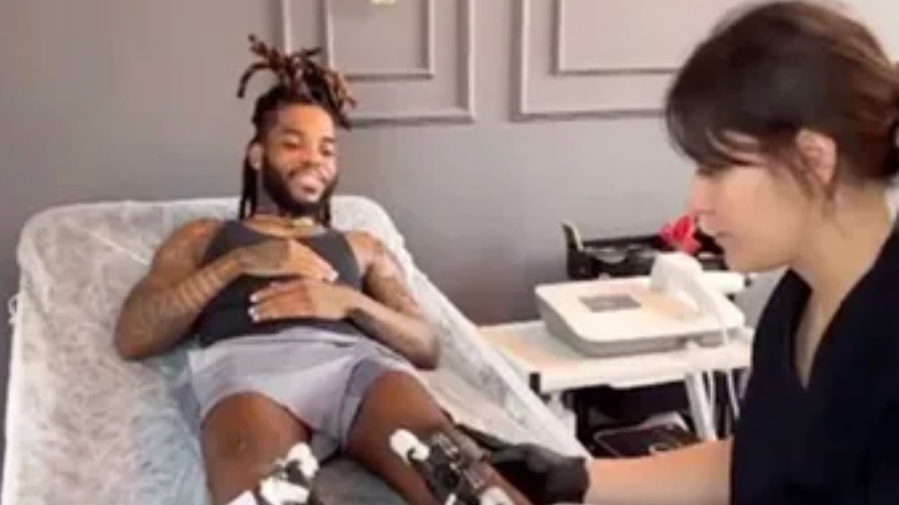 Dynzell Sigers se volvió más alto con la ayuda de aparatos que permitieron que los huesos generaran nueva materia osea. Tik Tok @mrbrokenbonezor