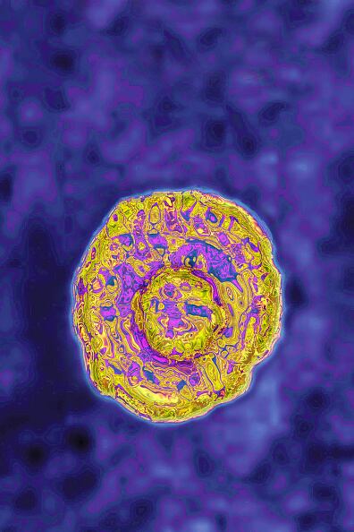 Se trata de una infección hepática muy contagiosa ocasionada por el virus de la hepatitis A, la cual se puede prevenir con una vacuna. (Photo by: BSIP/Universal Images Group via Getty Images)