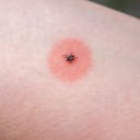 Vinagre de manzana para eliminar las garrapatas.