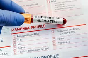 La anemia consiste en la deficiencia de glóbulos rojos.