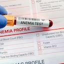 La anemia consiste en la deficiencia de glóbulos rojos.