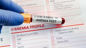 La anemia consiste en la deficiencia de glóbulos rojos.