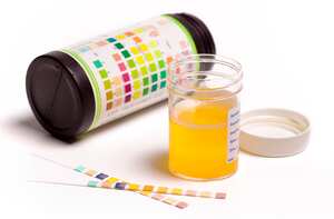 El color de la orina advierte sobre el consumo de algunos alimentos o medicamentos, pero también de posibles enfermedades.