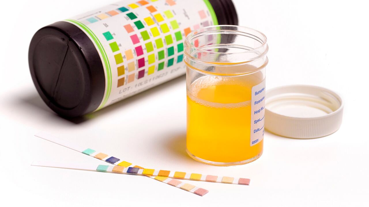 El color de la orina advierte sobre el consumo de algunos alimentos o medicamentos, pero también de posibles enfermedades.