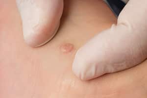 Son pequeños bultos granulares en la piel que aparecen con mayor frecuencia en los dedos o en las manos.