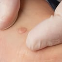 Son pequeños bultos granulares en la piel que aparecen con mayor frecuencia en los dedos o en las manos.