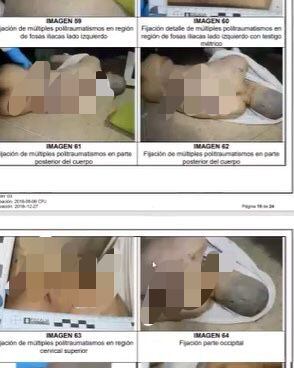 La Fiscalía reveló detalles de la necropsia hecha al cuerpo de Juan Pablo González, el presunto abusador de Hilary. Más de 50 golpes y fracturas.