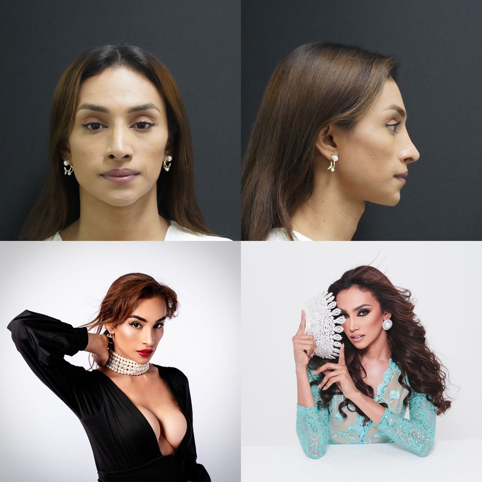 Cirugía de feminización facial realizada por Ricardo Morales