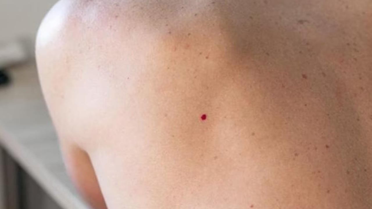 Los puntos rojos en la piel son pequeñas manchitas vasculares sobreelevadas.