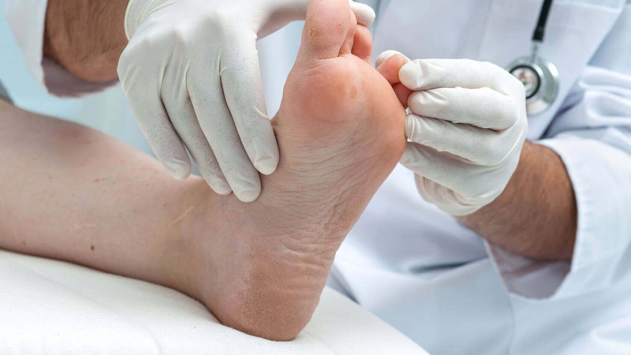 Acuda al médico pronto si considera que tiene pie de atleta.