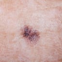 Manchas - cáncer de piel