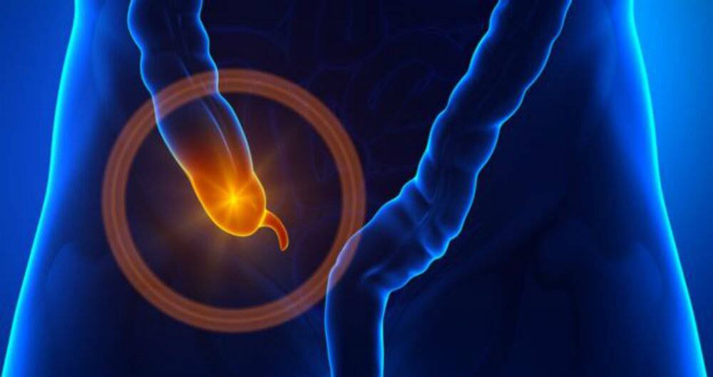 Cuando esta parte del cuerpo se inflama aparece la apendicitis.