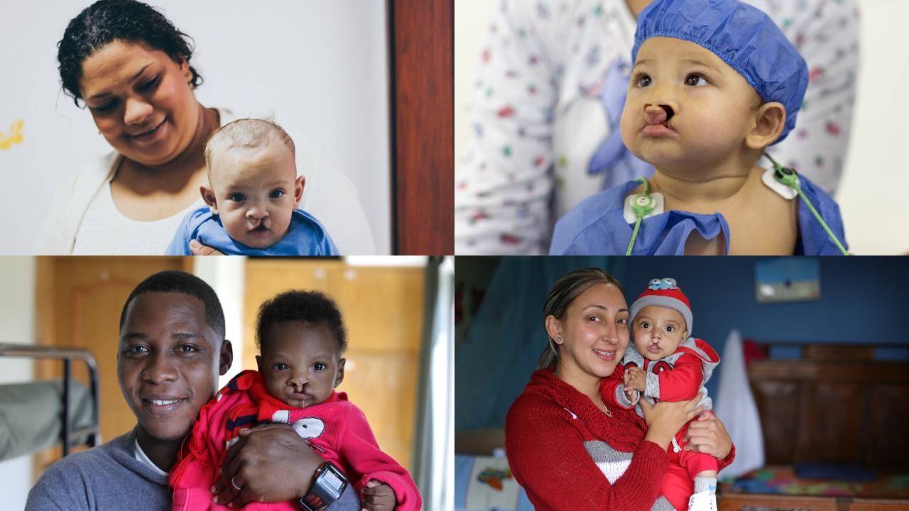 Menores con labio hendido en el Urabá podrán ser operados gracias a jornada de médica.
