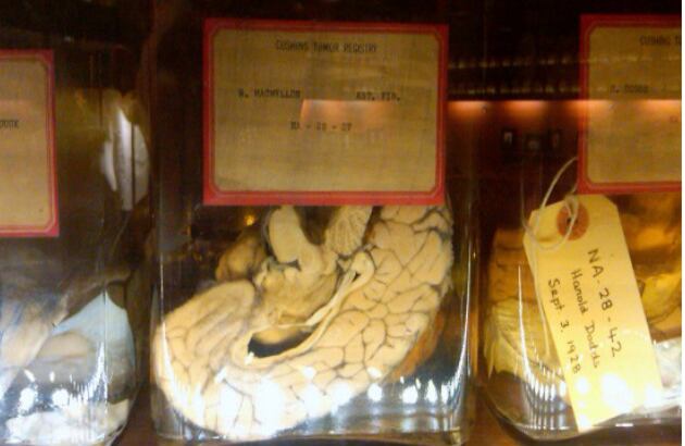 Una de las características más especiales de la Colección Cushing es que la mayoría de cerebros exhibidos tienen tumores cancerígenos y lesiones de otro tipo. La persona a la que perteneció este cerebro padeció fibrosis. 