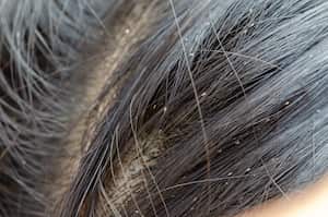 Tanto los piojos como las liendres suelen aparecer en el cuero cabelludo de los niños menores de 11 años de edad.