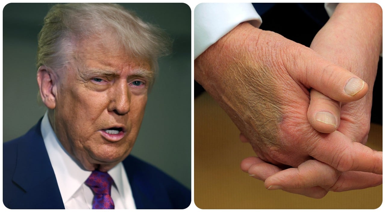 El mandatario aseguró que no hay indicios de "trombosis venosa profunda o enfermedad arterial"