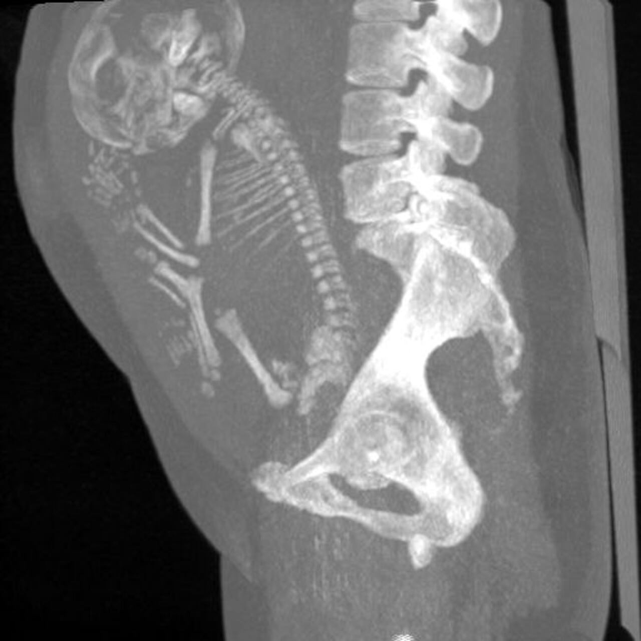 Radiografía abdominal. La mujer de 84 años habría tenido el feto dentro de su vientre desde hace 40 años