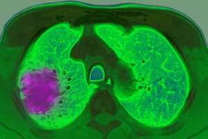 Una investigación española pionera a nivel mundial logró consolidar un nuevo estándar de tratamiento para el cáncer de pulmón inicial, que permitirá aumentar un 20 % la supervivencia y beneficiará a más de 6.000 pacientes en ese país cada año.