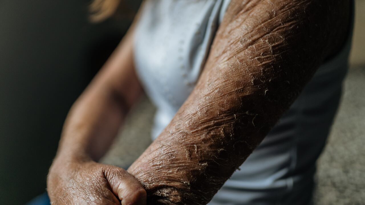 La ictiosis debe ser tratada por un profesional de la salud.