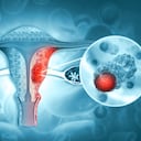 Enfermedades del sistema reproductivo femenino.cáncer de útero y tumor maligno de endometrio como concepto médico uterino.