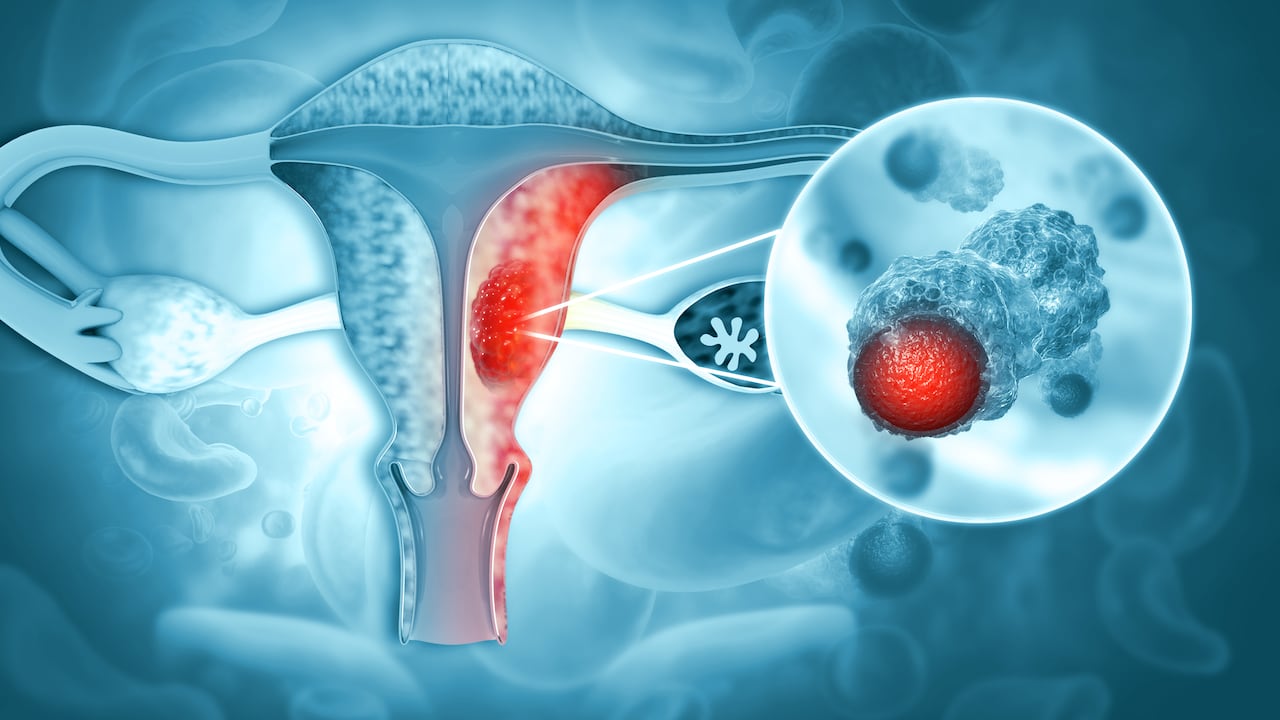 ¿Qué causa el cáncer de cuello uterino?