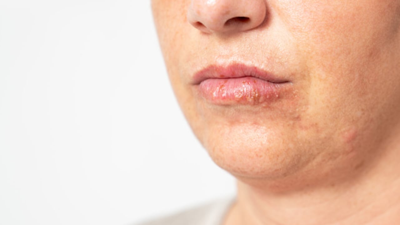 Esta infección se contagia por contacto directo y algunas personas no presentan síntomas.