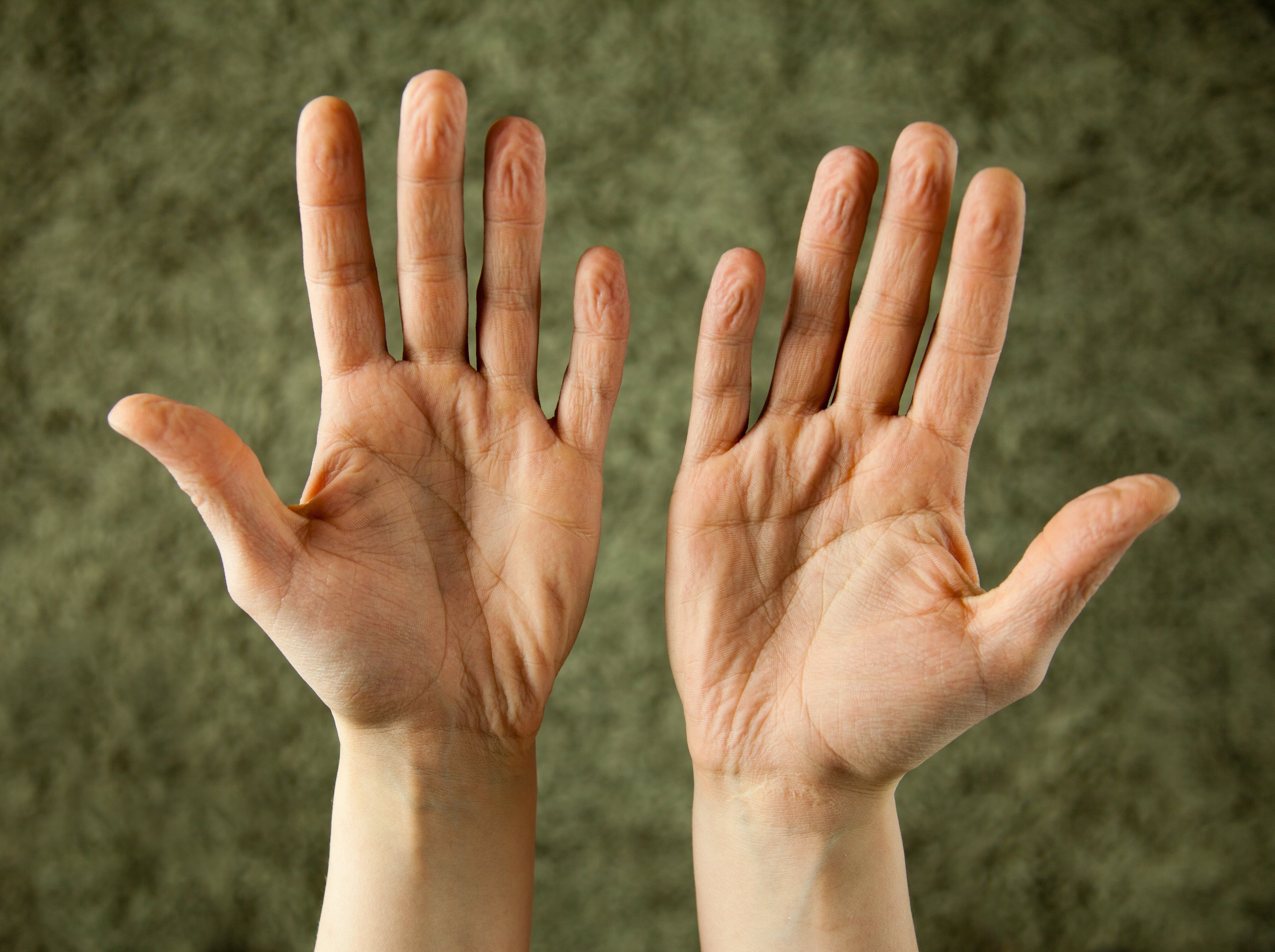 Es normal que los dedos de las manos y de los pies se arruguen al contacto con el agua