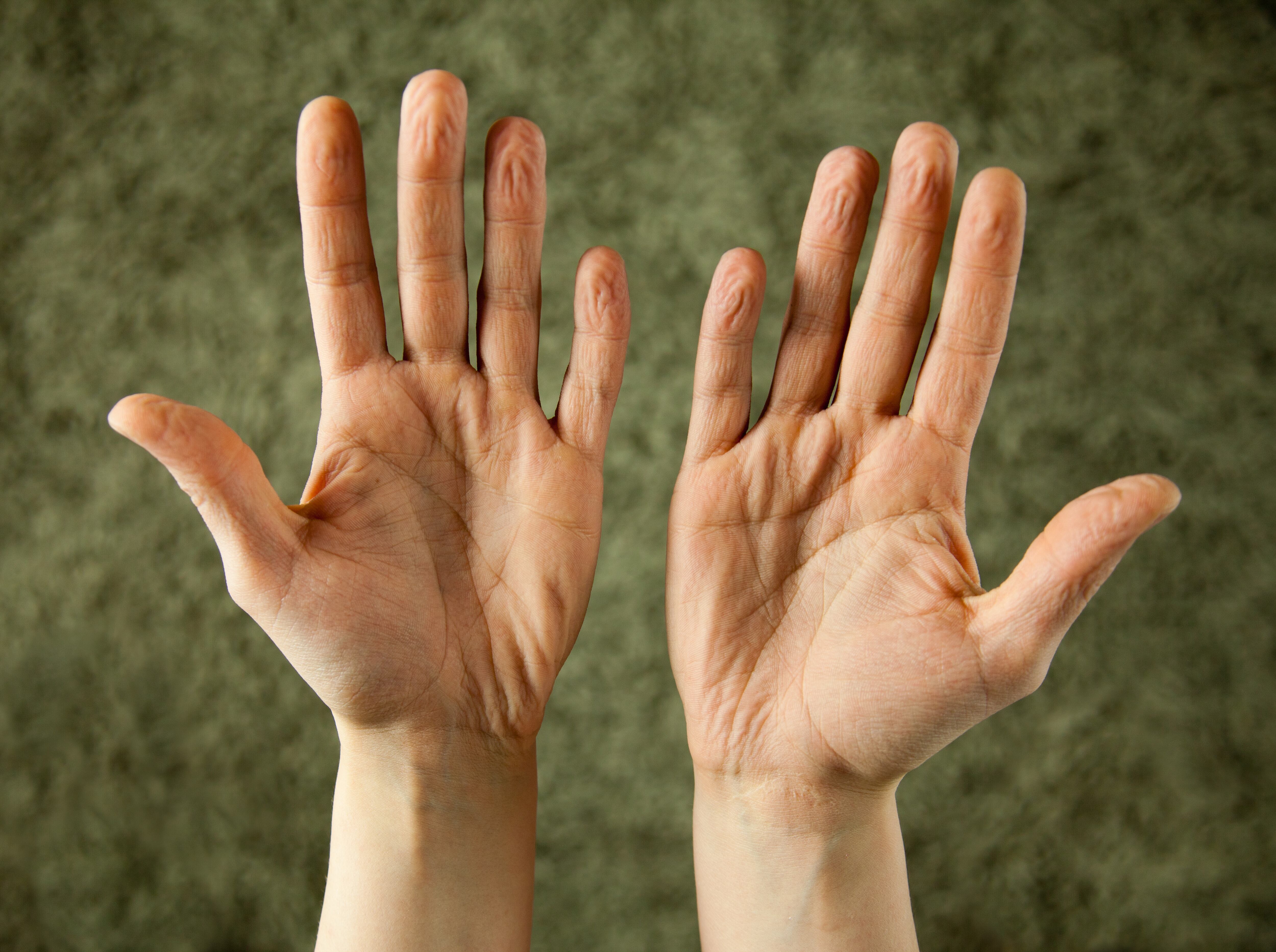 Es normal que los dedos de las manos y de los pies se arruguen al contacto con el agua