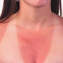 Foto de referencia sobre piel quemada