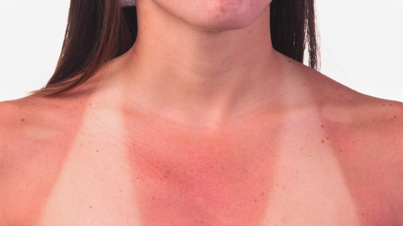 Foto de referencia sobre piel quemada