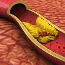 Cómo limpiar las arterias de forma natural