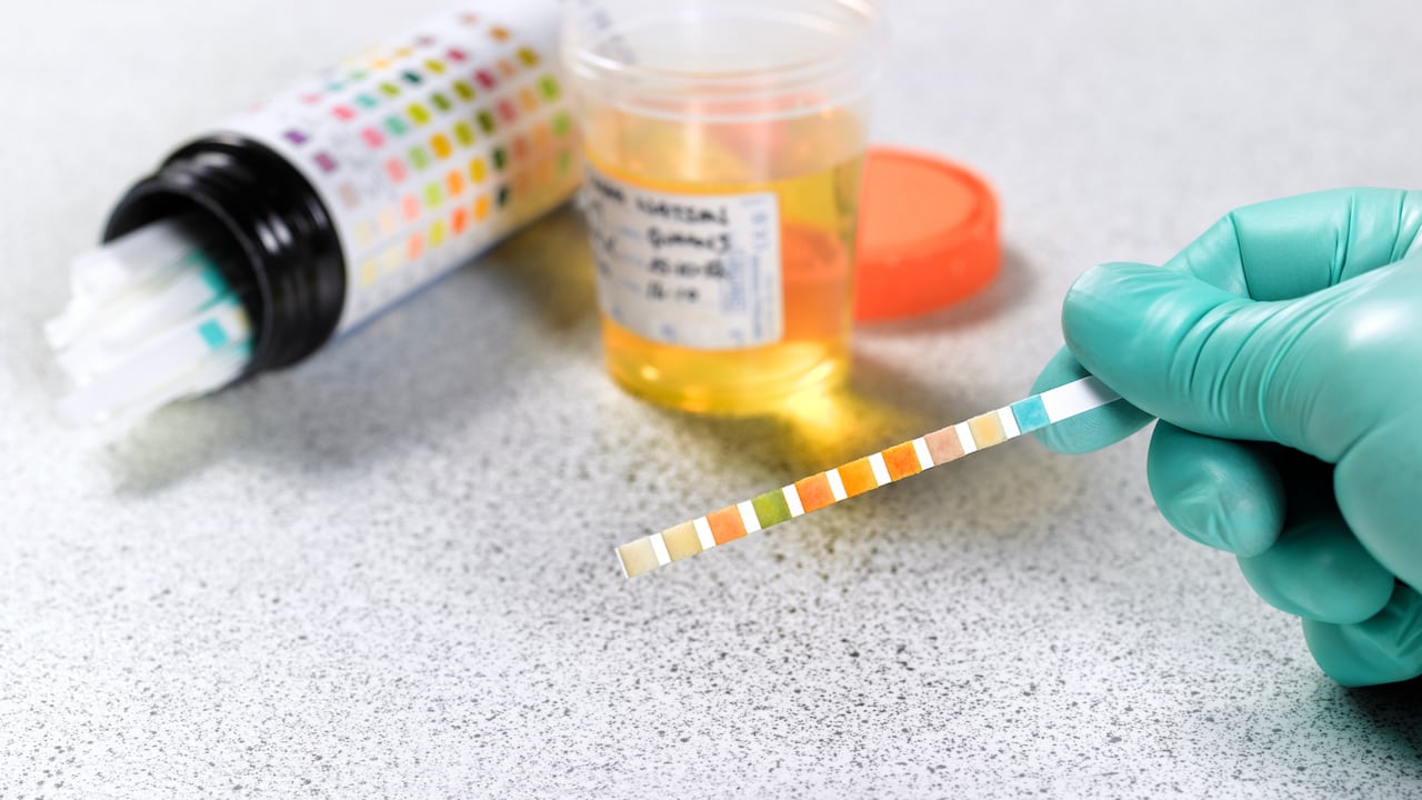 Representación de ácido úrico