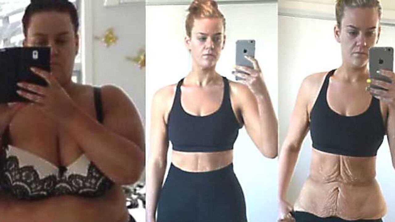 Simone Anderson empezando su proceso y antes de someterse a la abdominoplastia.